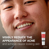 Neutrogena Rapid Clear Stubborn Acne Spot Treatment Gel with Maximum Strength 10% Benzoyl Peroxide Acne Treatment Medication, Pimple Cream for Acne Prone Skin Care, 1 Oz