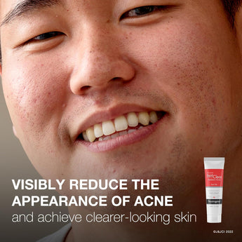Neutrogena Rapid Clear Stubborn Acne Spot Treatment Gel with Maximum Strength 10% Benzoyl Peroxide Acne Treatment Medication, Pimple Cream for Acne Prone Skin Care, 1 Oz